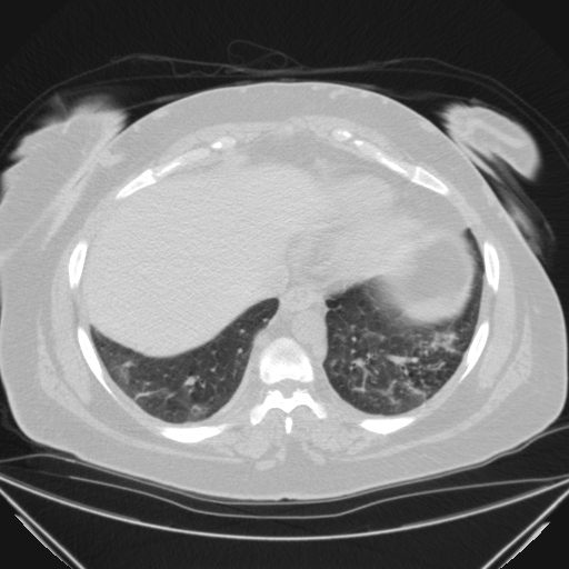 File:Aspergilloma (Radiopaedia 39611-41932 Axial lung window 107).jpg
