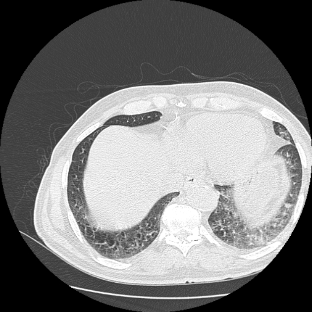 Aspergilloma (Radiopaedia 44592-48327 Axial lung window 74).jpg