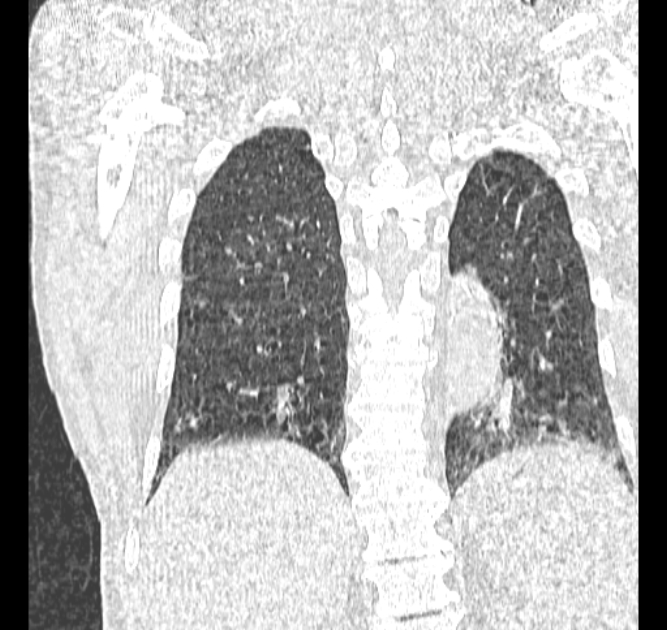 Aspergilloma (Radiopaedia 44592-48327 Coronal lung window 102).jpg