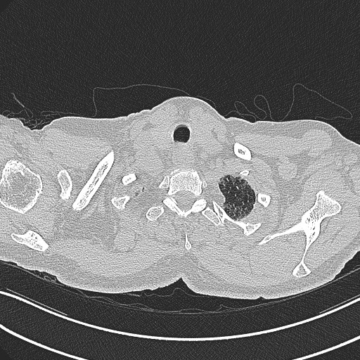 File:Aspergilloma on background pulmonary fibrosis (Radiopaedia 60942-68757 B 6).jpg