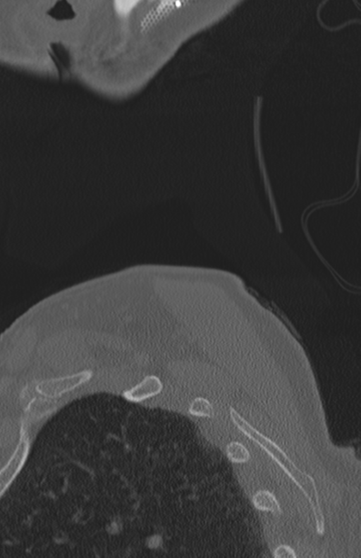 Atlanto-axial subluxation (Radiopaedia 36610-38176 Sagittal bone window 82).png