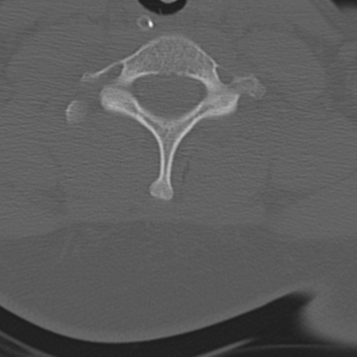 Atlanto-occipital dissociation (Radiopaedia 33848-35013 Axial bone window 39).png