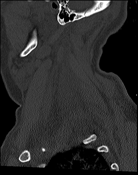 Atlanto-occipital dissociation - Traynelis type 1 (Radiopaedia 87570-103948 Sagittal bone window 68).jpg