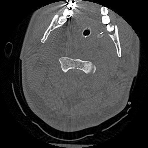 Atlanto-occipital dissociation injury (Radiopaedia 29274-29698 Axial bone window 20).png
