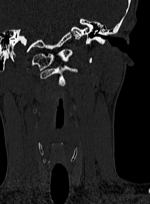 Atlantoaxial subluxation (Radiopaedia 44681-48450 Coronal bone window 6).jpg