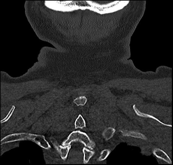 Atlas (type 3b subtype 1) and axis (Anderson and D'Alonzo type 3, Roy-Camille type 2) fractures (Radiopaedia 88043-104607 Coronal bone window 58).jpg