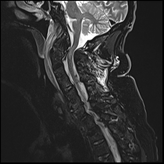 File:Atlas (type 3b subtype 1) and axis (Anderson and D'Alonzo type 3, Roy-Camille type 2) fractures (Radiopaedia 88043-104610 Sagittal STIR 5).jpg