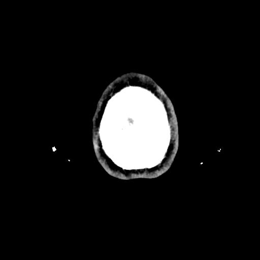 Atretic cephalocele (Radiopaedia 89782-106881 Axial with contrast 184).jpg