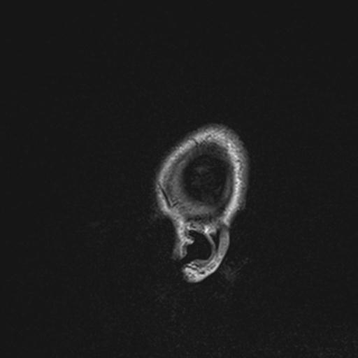 Atretic encephalocoele with inferior vermis hypoplasia (Radiopaedia 30443-31108 Sagittal FLAIR 149).jpg