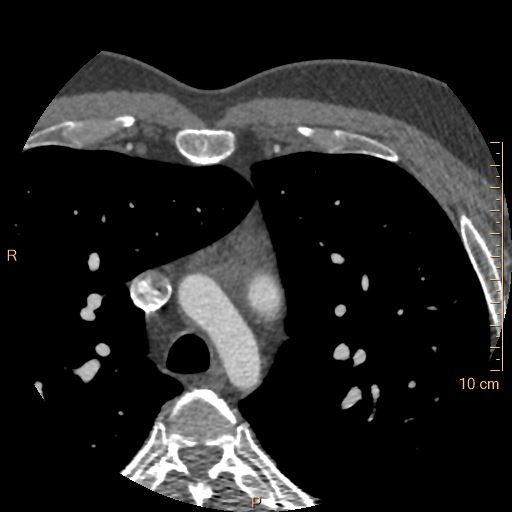 Atrial septal defect (upper sinus venosus type) with partial anomalous pulmonary venous return into superior vena cava (Radiopaedia 73228-83961 A 10).jpg