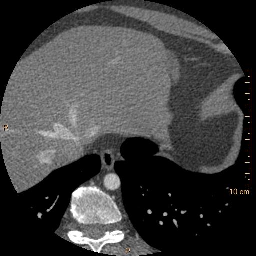 File:Atrial septal defect (upper sinus venosus type) with partial anomalous pulmonary venous return into superior vena cava (Radiopaedia 73228-83961 A 264).jpg