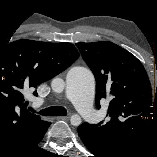 Atrial septal defect (upper sinus venosus type) with partial anomalous pulmonary venous return into superior vena cava (Radiopaedia 73228-83961 A 36).jpg