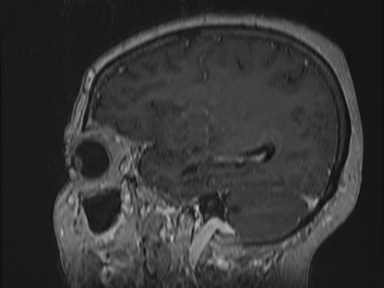 Atypical meningioma (Radiopaedia 62985-71406 Sagittal T1 C+ 21).jpg