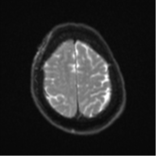 File:Atypical meningioma (WHO Grade II) (Radiopaedia 54742-60981 Axial DWI 23).png