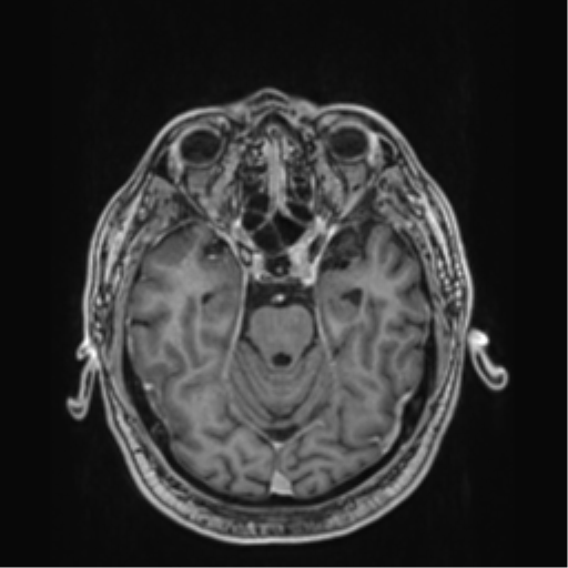 File:Atypical meningioma (WHO grade II) with brain invasion (Radiopaedia 57767-64729 Axial T1 C+ 16).png