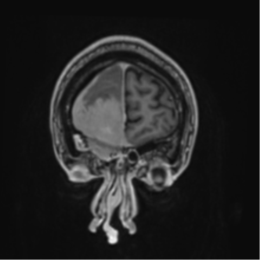 Atypical meningioma (WHO grade II) with brain invasion (Radiopaedia 57767-64729 Coronal T1 C+ 5).png