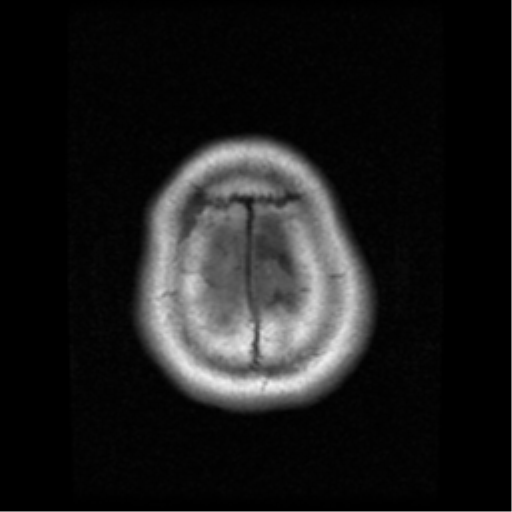 File:Atypical meningioma (WHO grade II) with osseous invasion (Radiopaedia 53654-59716 Axial T1 21).png