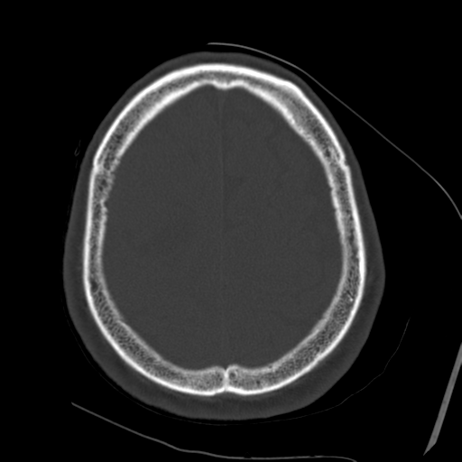 File:Atypical meningioma with skull invasion (Radiopaedia 34357-35649 Axial bone window 65).png