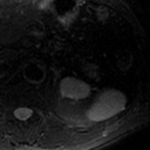 File:Atypical renal cyst on MRI (Radiopaedia 17349-17046 Axial T2 fat sat 3).jpg