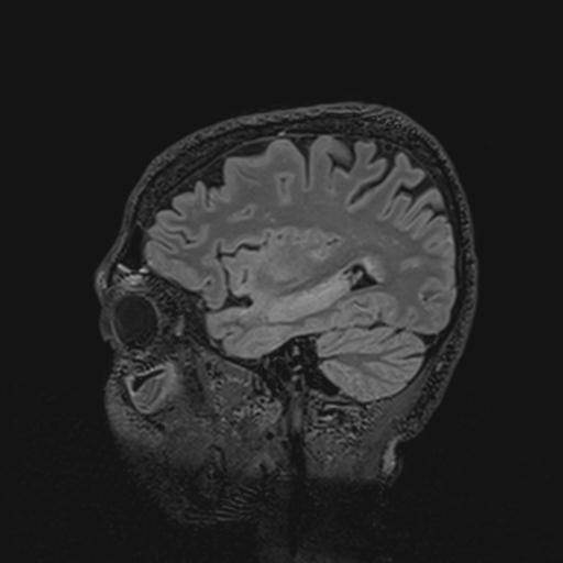 Autoimmune limbic encephalitis (Radiopaedia 30363-31005 Sagittal FLAIR 112).jpg