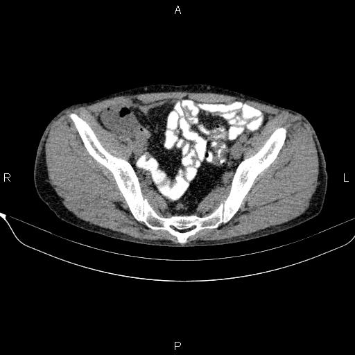 Autoimmune pancreatitis (Radiopaedia 84925-100431 Axial non-contrast 46).jpg