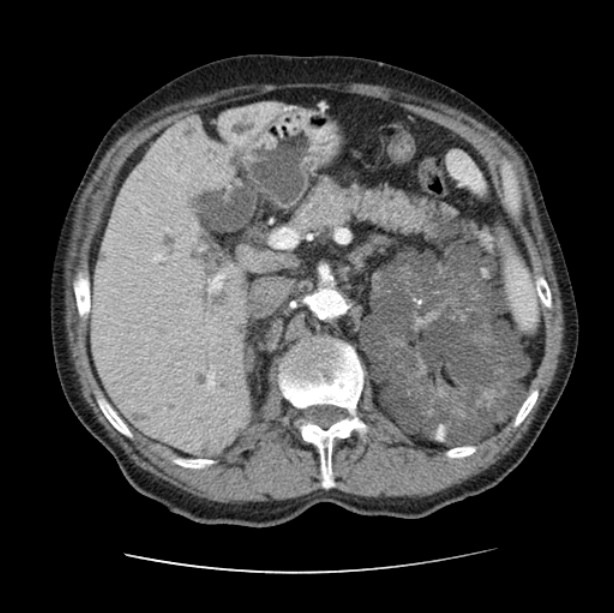 Autosomal dominant polycystic kidney disease (Radiopaedia 27851-28094 B 64).jpg
