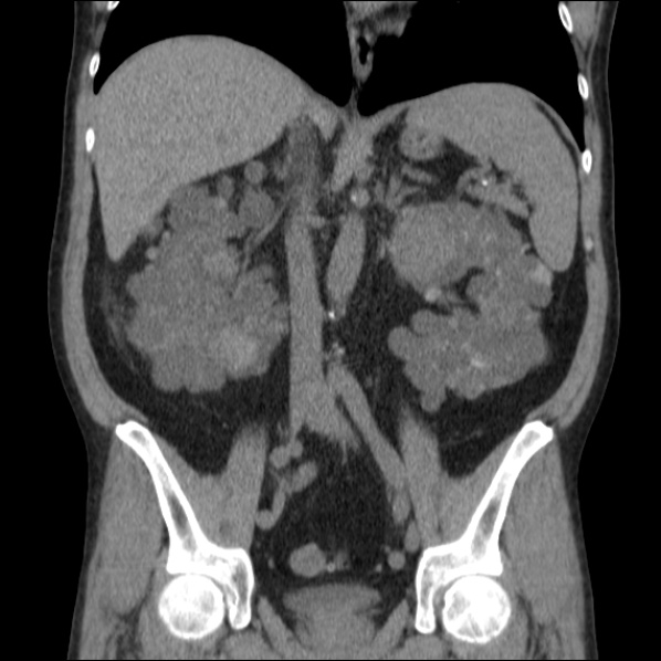 File:Autosomal dominant polycystic kidney disease (Radiopaedia 36539-38101 C 38).jpg