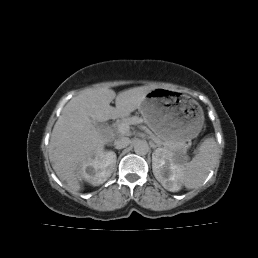 File:Autosomal dominant polycystic kidney disease (Radiopaedia 38189-40194 Axial C+ delayed 13).jpg