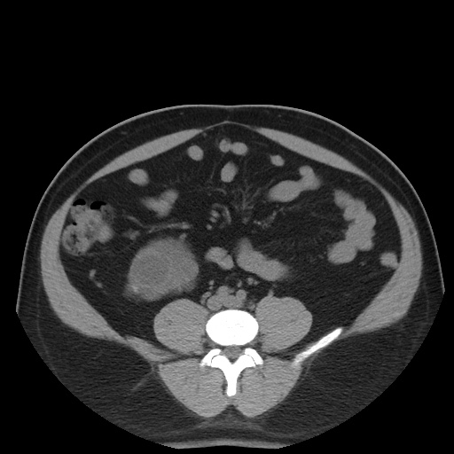 File:Autosomal dominant polycystic kidney disease (Radiopaedia 50259-55612 Axial non-contrast 54).jpg