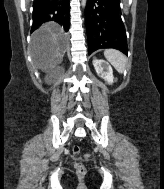 Autosomal dominant polycystic kidney disease (Radiopaedia 57124-64017 B 59).jpg