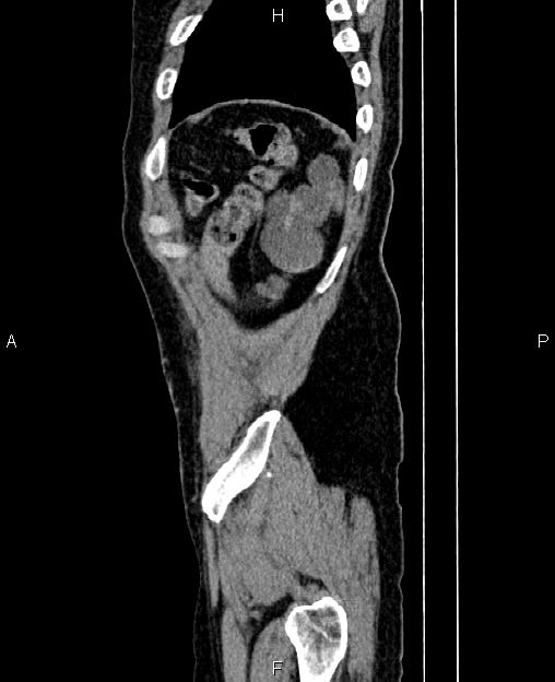 Autosomal dominant polycystic kidney disease (Radiopaedia 87830-104287 C 86).jpg