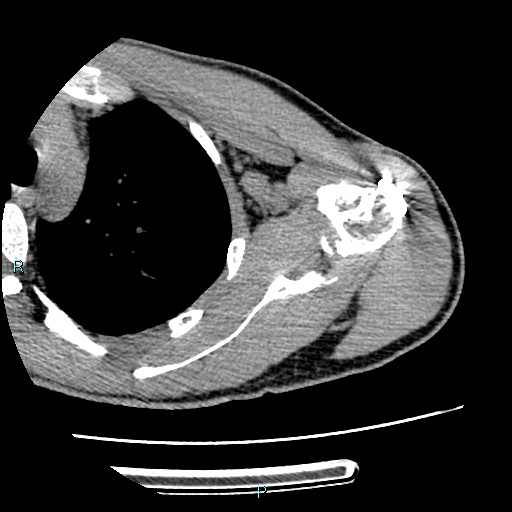 Avascular necrosis after fracture dislocations of the proximal humerus (Radiopaedia 88078-104655 D 59).jpg