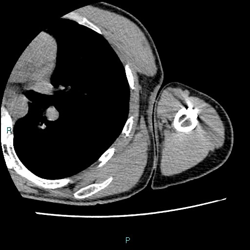 File:Avascular necrosis after fracture dislocations of the proximal humerus (Radiopaedia 88078-104655 D 91).jpg