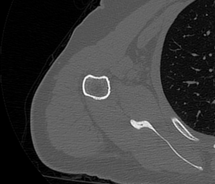 Avulsion fracture - greater tuberosity of humerus (Radiopaedia 71216-81514 Axial bone window 58).jpg