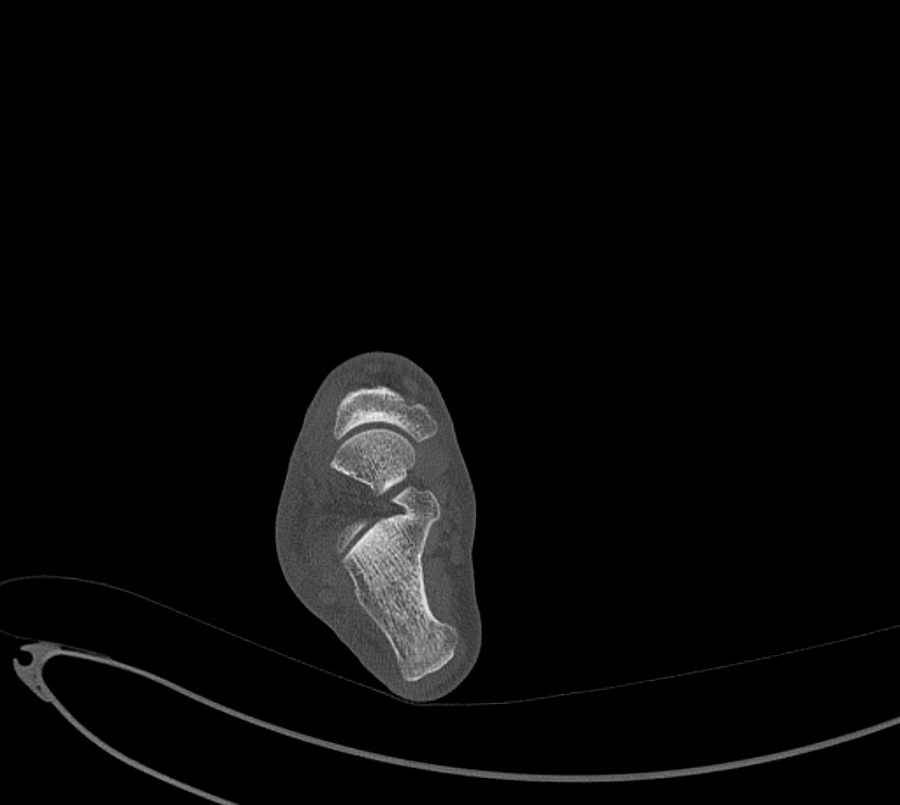 Avulsion fractures of talus and calcaneus (Radiopaedia 48277-53155 Axial bone window 48).jpg