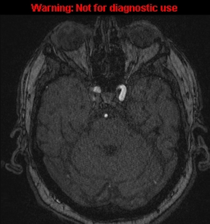 Azygos anterior cerebral artery (Radiopaedia 59325-66677 Axial MRA 48).jpg