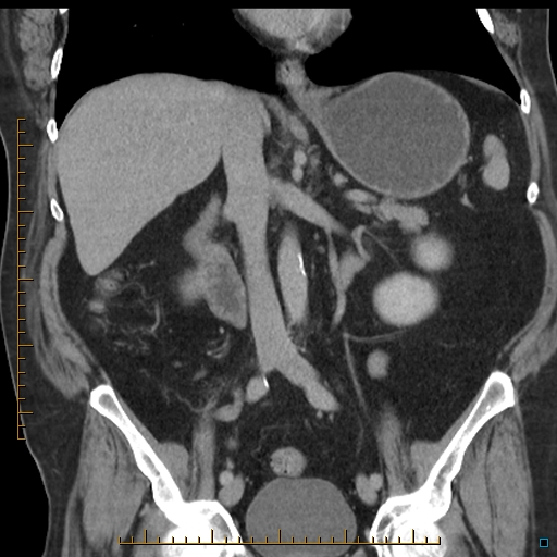 File:Bariatric balloon causing gastric outlet obstruction (Radiopaedia 54449-60672 B 32).jpg