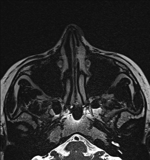 Basal cell carcinoma - nasal region (Radiopaedia 70292-80365 Axial Gradient Echo 27).jpg