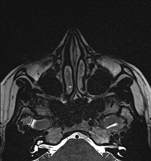 Basal cell carcinoma - nasal region (Radiopaedia 70292-80365 Axial Gradient Echo 40).jpg