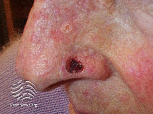 File:Basal cell carcinoma affecting the nose (DermNet NZ lesions-bcc-nose-1036).jpg