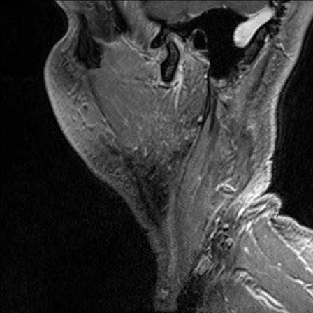 Base of tongue squamous cell carcinoma (Radiopaedia 31174-31884 F 156).jpg