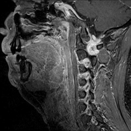 Base of tongue squamous cell carcinoma (Radiopaedia 31174-31884 F 72).jpg