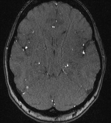 Basilar tip aneurysm (Radiopaedia 26504-26632 MRA 101).jpg