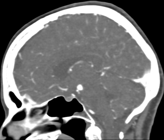 File:Basilar tip aneurysm with coiling (Radiopaedia 53912-60086 C 62).jpg