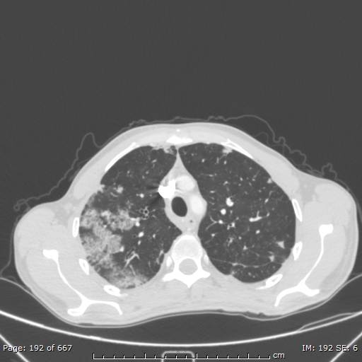 Behçet disease (Radiopaedia 44247-47889 Axial lung window 22).jpg