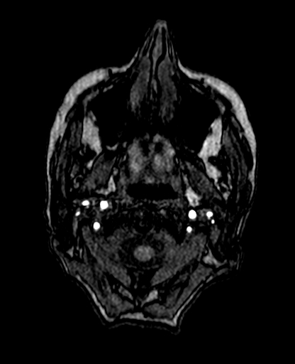 File:Berry aneurysm of the terminal internal carotid artery (Radiopaedia 88286-104918 Axial TOF 18).jpg