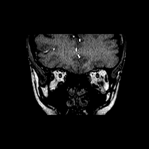 Berry aneurysm of the terminal internal carotid artery (Radiopaedia 88286-104918 Coronal TOF 8).jpg
