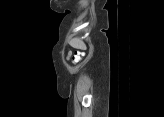 Bicameral celiacomesenteric aneurysm (Radiopaedia 55766-62327 B 6).jpg