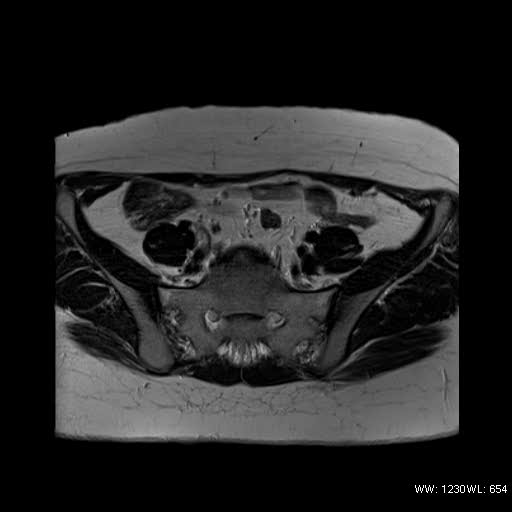 File:Bicornuate uterus- on MRI (Radiopaedia 49206-54297 Axial T2 1).jpg
