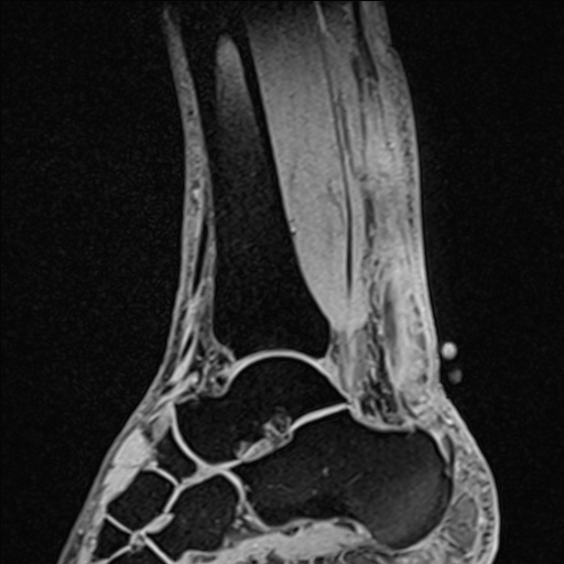Bilateral Achilles tendon complete tear (Radiopaedia 81344-95051 Sagittal WE - Right 57).jpg
